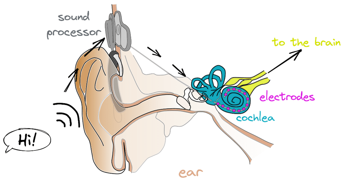 Can we improve what people hear through cochlear implants? - The Evelyn ...